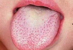 吃瓜感觉舌头有点刺