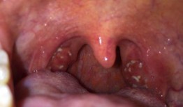 吃瓜粘喉咙咽不下,揭秘夏日饮食小贴士