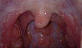 吃瓜粘喉咙咽不下,揭秘夏日饮食小贴士